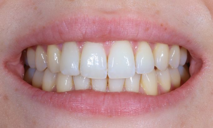 After -Gibside Dental