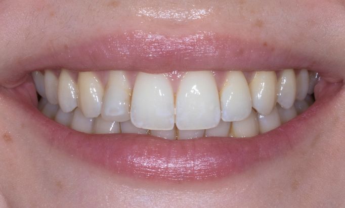 Before - Gibside Dental