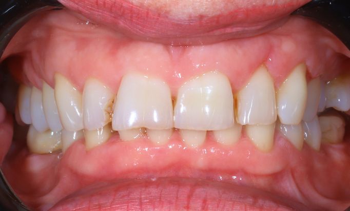 Before - Gibside Dental