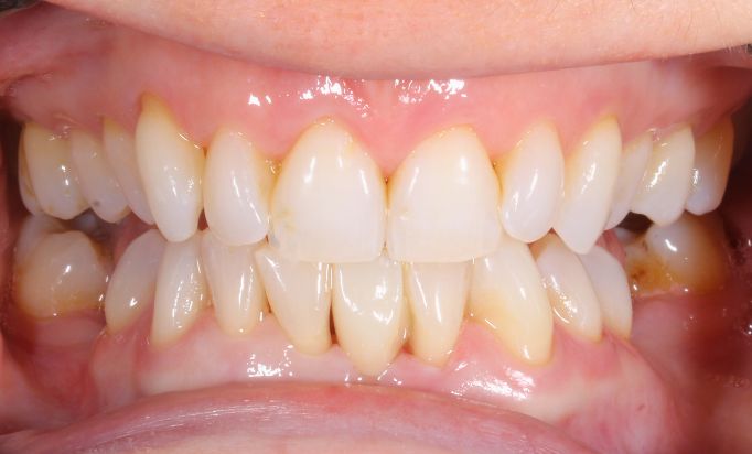 After - Gibside Dental