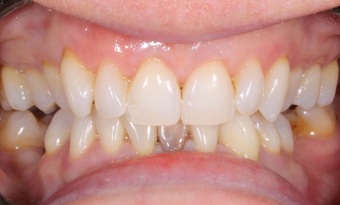 Before - Gibside Dental