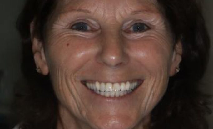 Smile Gallery -Gibside Dental