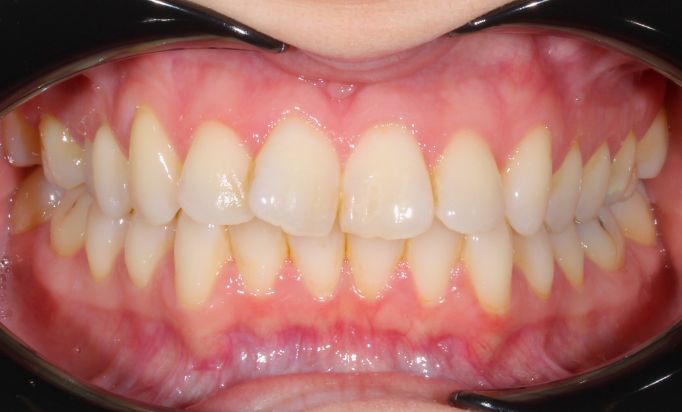 Before - Gibside Dental