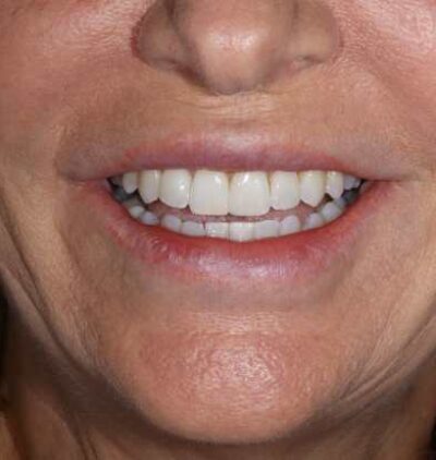 Smile Gallery - Gibside Dental