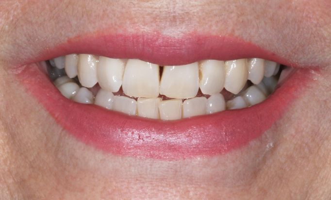 Before - Gibside Dental