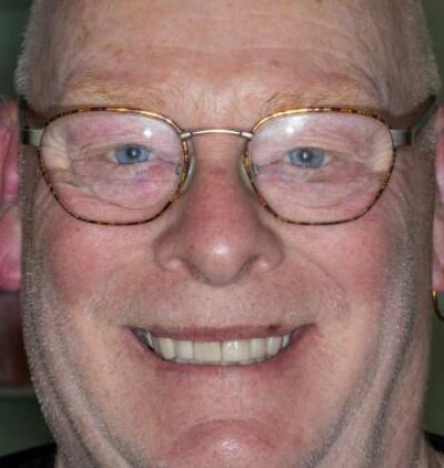 Smile Gallery - Gibside Dental