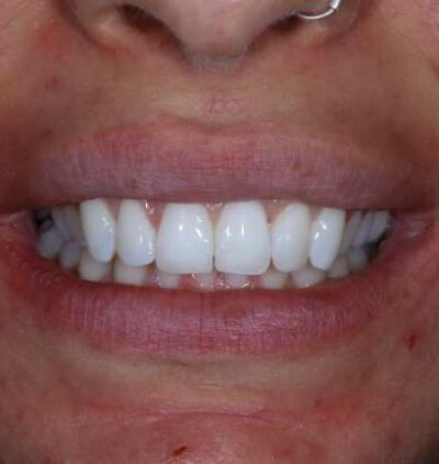 Smile Gallery - Gibside Dental