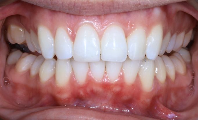 After -Gibside Dental