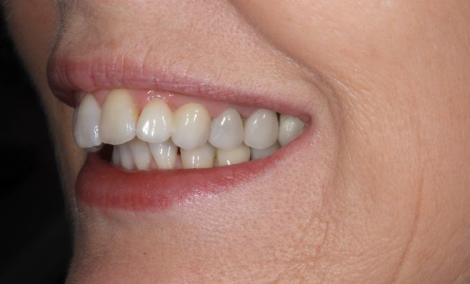 After - Gibside Dental