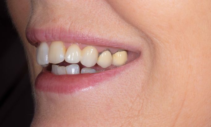 Before - Gibside Dental