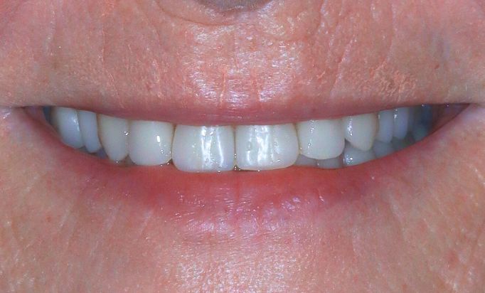 After -Gibside Dental