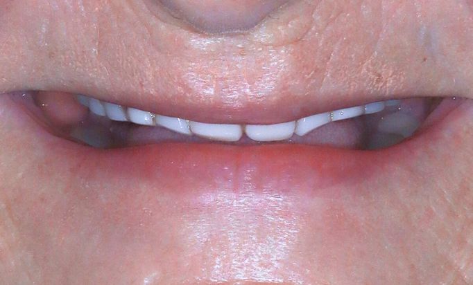 Before - Gibside Dental