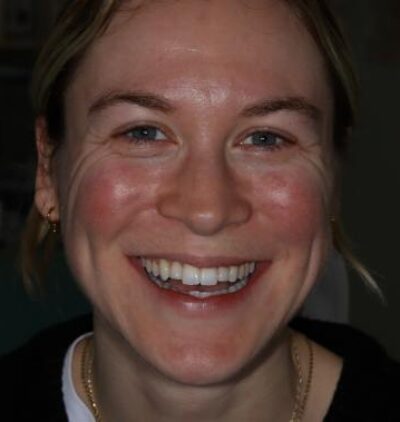 Smile Gallery - Gibside Dental