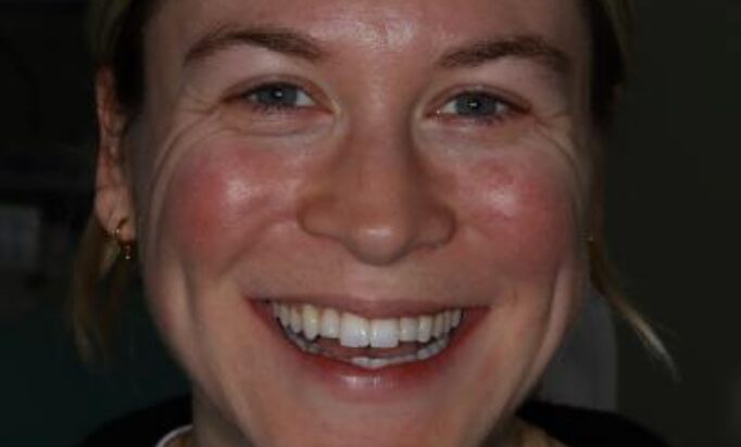 Smile Gallery -Gibside Dental