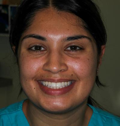 Smile Gallery - Gibside Dental