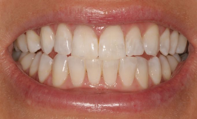 After - Gibside Dental