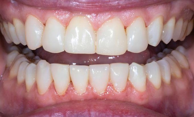 After -Gibside Dental